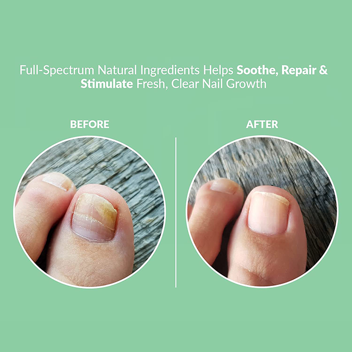 Nailrapy™ Fungus Nail Repair Gel
