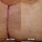 BIOCLEAR™ Silicone Scar Reduction Sheets